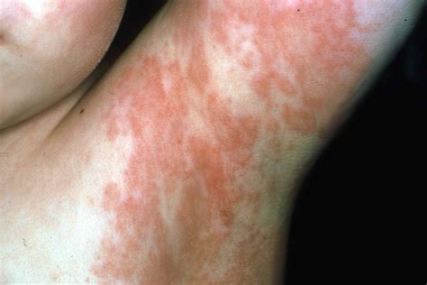 Are Viral Rashes Common In Children - Infoupdate.org