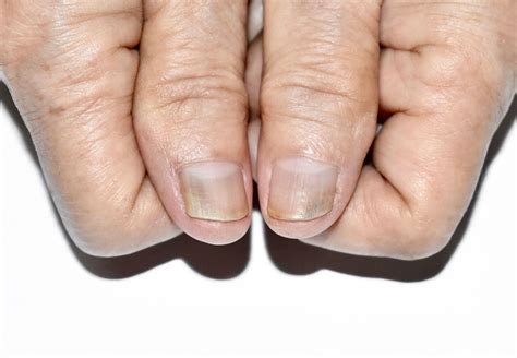nail problems treatment  singapore lumine dermatology laser clinic