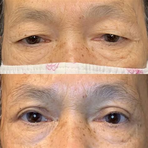 Blepharoplasty Panama City | Eyelid Surgery Panama City Beach