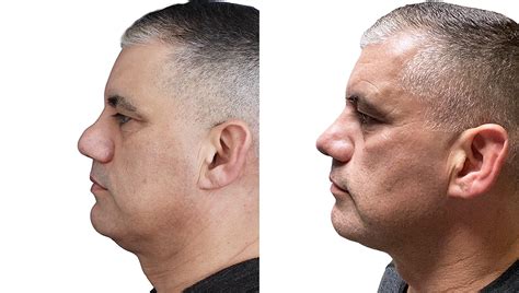 Nariz De Batata Feio - Rinoplastia no nariz de batata (Ponta Bulbosa)