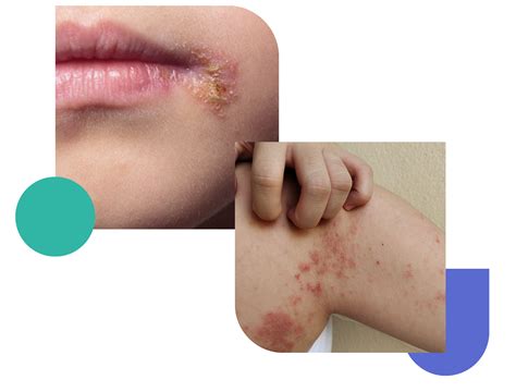 Get Dermatologist-Prescribed Impetigo Treatment Online