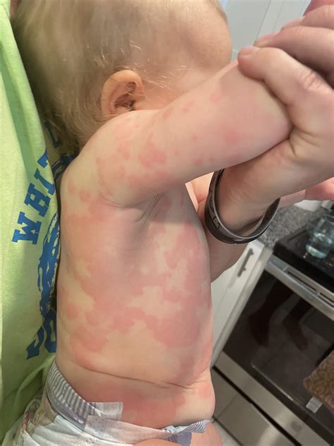 Peanut Allergy Rash Advancements Offer Hope That Kids Can Outgrow