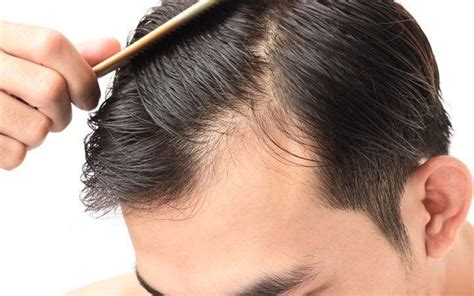 Does Nicotine Cause Hair Loss ? - My Glow Journey