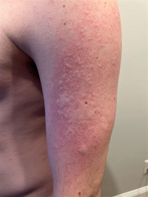 Itchy, red patch on skin with raised bumps : r/medical_advice