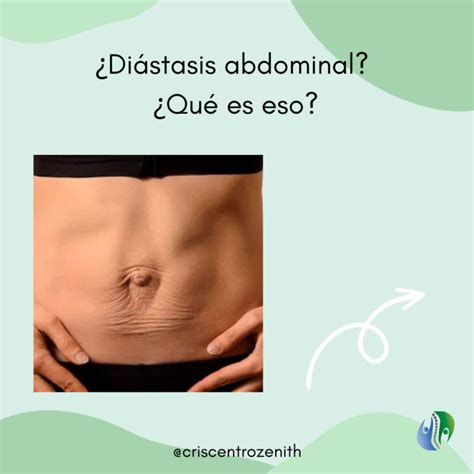 Diástasis abdominal, ¿Qué es eso? • Clínica Zenith