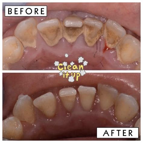 teeth deep cleaning