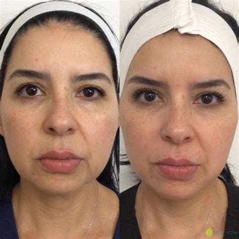 Best Treatments for Ozempic Face Aging and Butt Fat Loss - Reston ...