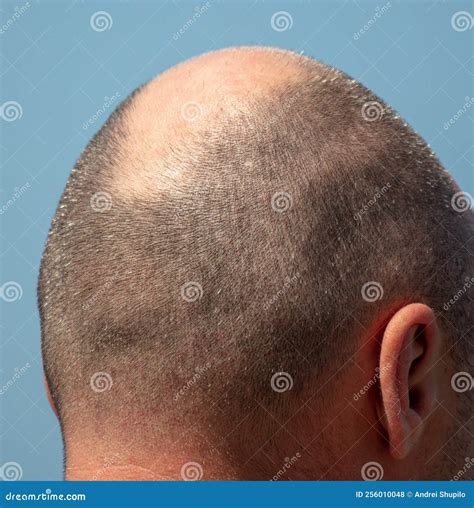 bald patch   man  head   sky stock photo image  neck