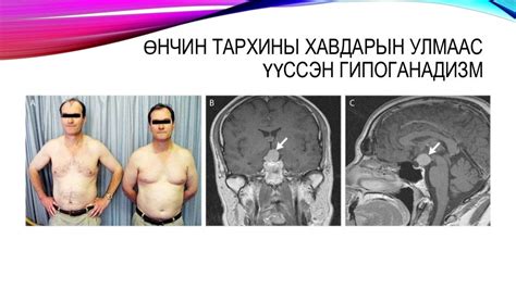 бэлгийн булчирхайн эмгэгүүд