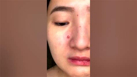 This Unbelievable Blackhead Removal 2024 Method is Taking Over TikTok! - gszbezz