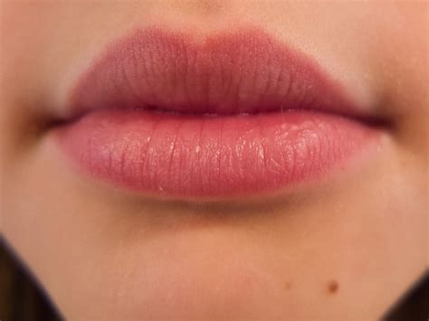 Mild Herpes On Lips