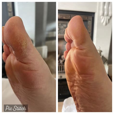 Foot - Callus. gone 🧚‍♀️ Hard skin removal Keeping the feet smooth and