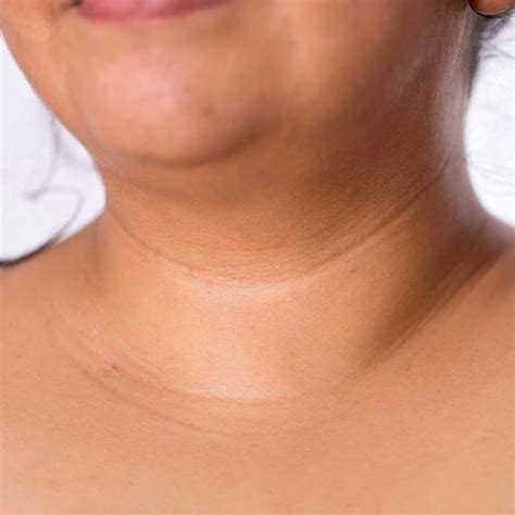 neck lines facial aesthetics