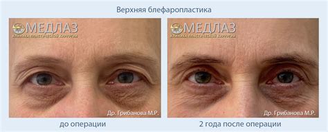 Блефаропластика до и после: фото результатов в клинике МедЛаз