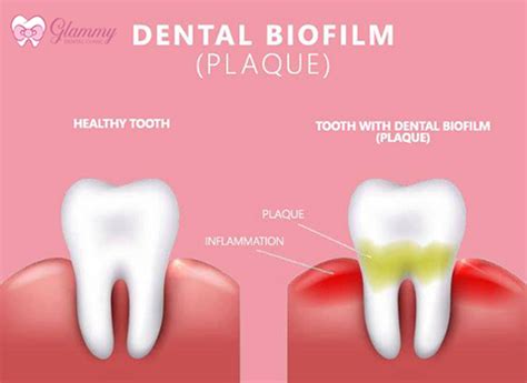 Benefits of Biofilm Focused Dental Care