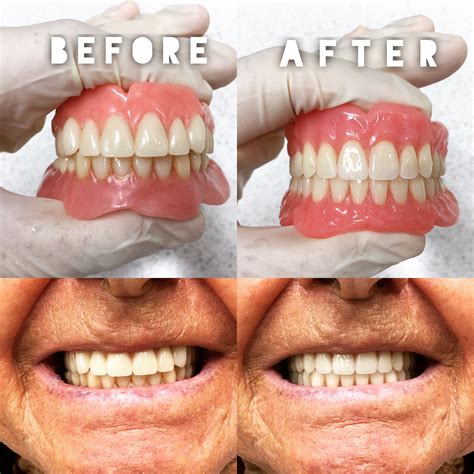 Temporary vs permanent denture – Artofit