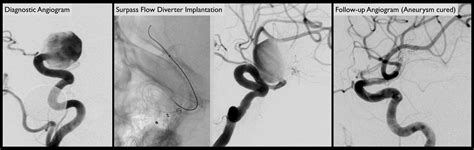 cerebral aneurysms dr alexander  coon