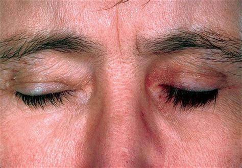 Periocular Cutaneous Pigmentary Changes Associated With Bimatoprost Use ...