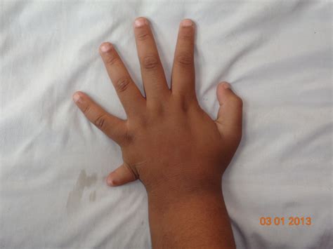 Bardet biedel syndrome: a very rare entity in India. - Abstract ...