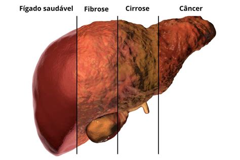 Inflamação Do Fígado Nome - Primeiros sintomas de gordura no fígado: entenda as causas