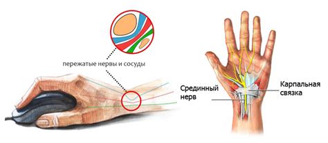 Синдромом карпального канала - лечить | Sustav.pro