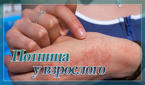 Потница у взрослых: фото, симптомы и лечение в домашних условиях
