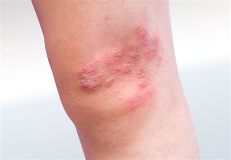 skin conditionskneefront  relieve foot pain leg pain