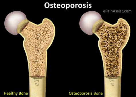 18. Causes of atrophy; general gross morphology and microscopical ...