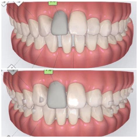 my front tooth broken at the gum line 5