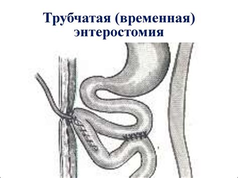 Топографическая анатомия и оперативная хирургия тонкой и толстой кишки ...