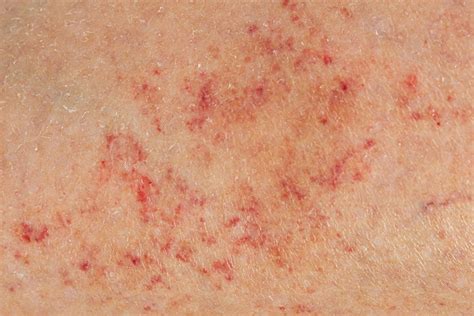 petechiae  treatment     doctor myvisionorg