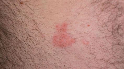 Shingles Rash Shingles Rash : Medical Treasure