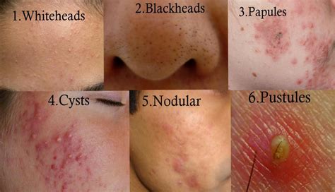 nodular acne  cystic acne