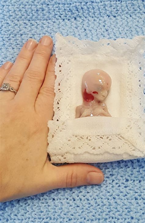 Photos of ‘Perfectly Formed’ 14-Week Miscarried Baby Are Saving Lives