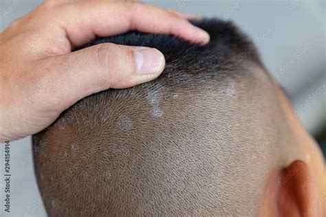 Eczema Dry Skin On Scalp at Gabriel Faulkner blog