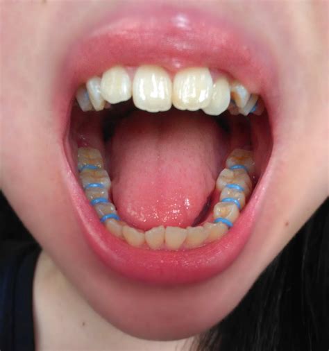 Teeth Pain In Braces at Henry Numbers blog
