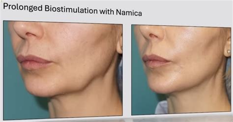 Технологията NAMICA - четвърта генерация конци Aptos