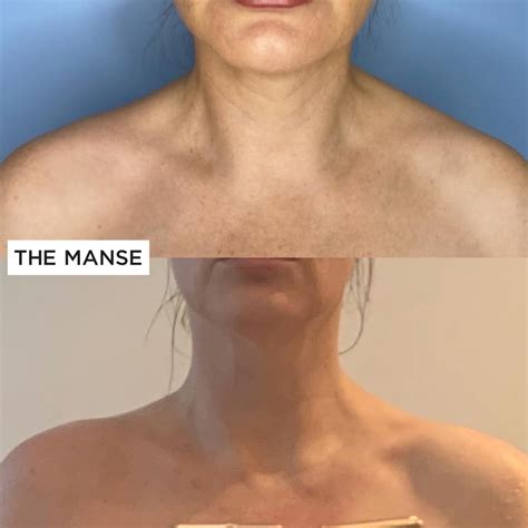 Trapezius slimming - THE MANSE CLINIC