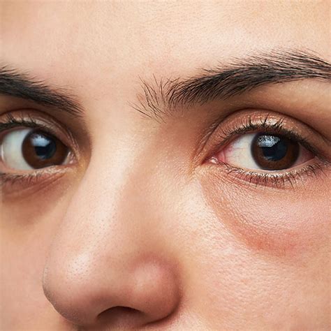 Drooping Eyelids | Causes & Treatments | Zia Cosmetic Clinic