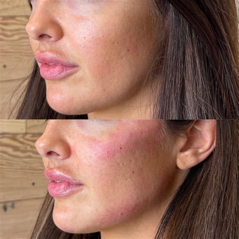 Jawline Fillers Treatment | Jaw Enhancement Manchester – klnik