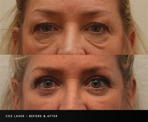 fractionated  laser  laser skin resurfacing  sculptra facial
