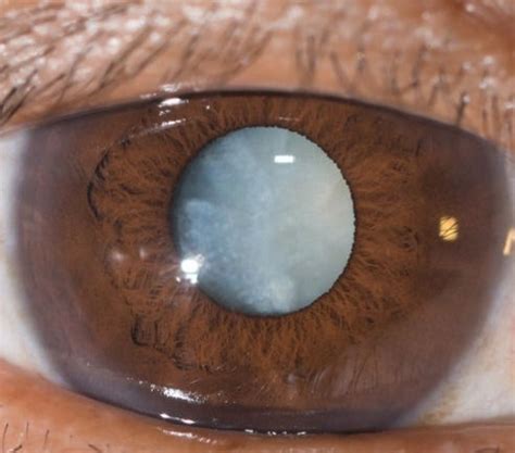eye conditions nanda dry eye vision institute united states