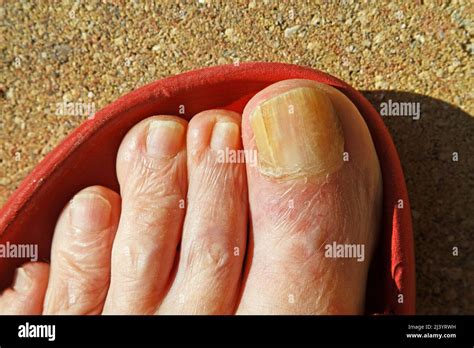 toenail fungus foot great toe close  medical condition disease