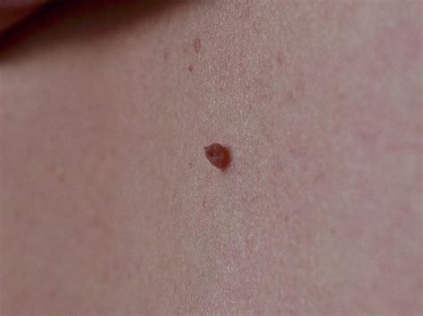 Skin Tags — Naples Dermatology