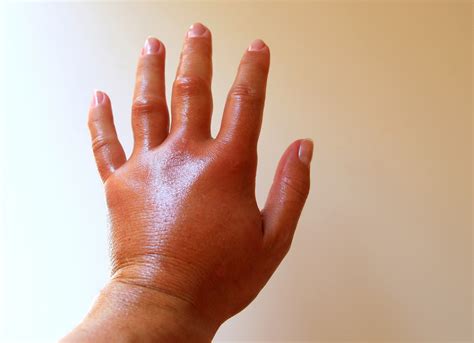 Wasp Sting Infection Signs