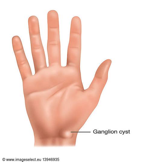 Ganglion Cyst Ganglion Cyst, Illustration,abnormal,abnormality ...