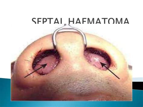SEPTAL-HAEMATOMA.pptx