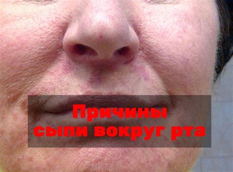 Сыпь вокруг рта: причины симптомы и лечение сыпи вокруг рта