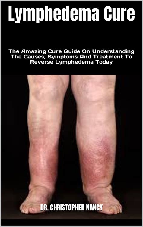 Lymphedema Cure : The Amazing Cure Guide On Understanding The Causes