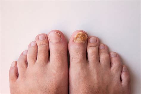 Nail Fungus | Oregon Foot Clinic